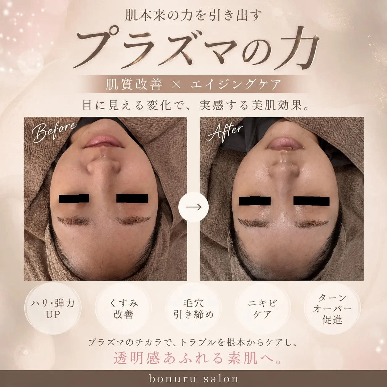 #プラズマ#肌育#毛穴#ニキビ改善 #くすみ