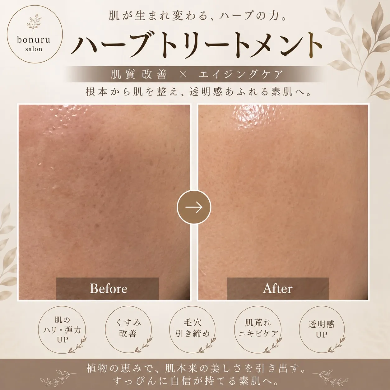 #ハーブトリートメント#ダウンタイムなし #肌質改善#ハリ艶...